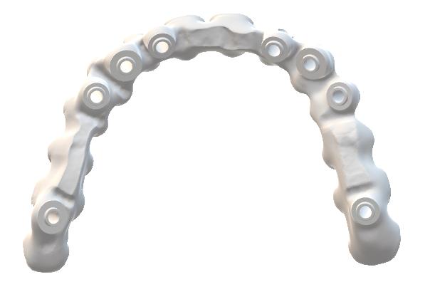 Superstructure supportée par implant.